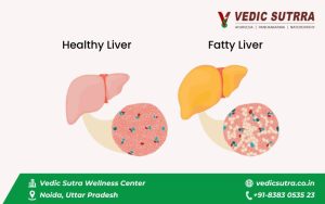 The Role of Panchakarma in Managing Fatty Liver Disease