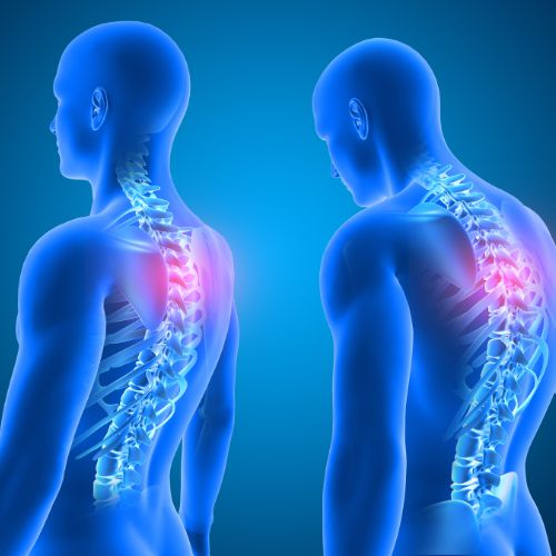 Bad Posture and Strain | Cervical Spondylitis | Vedic Sutrra Wellness Center | NOIDA